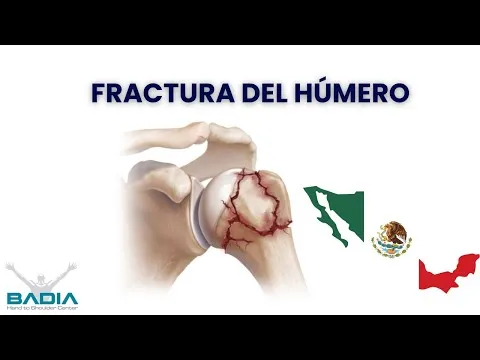Fractura del húmero, testimonio de paciente de México